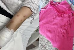 Lavabo açıcı bomba gibi patladı: Kolumdan vazgeçmiştim, yüzümden çok korktum