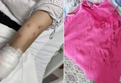Lavabo açıcı bomba gibi patladı: Kolumdan vazgeçmiştim, yüzümden çok korktum