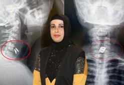 Boynuna takılan implant yemek borusunu yırtıp midesine düştü
