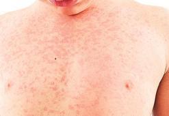 İstanbul’da kızamık tehlikesi: Aşı yaptırın