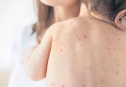 Kızamık salgını 2 ilde yükselişte