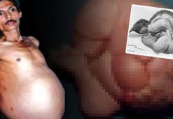 Tümör sandılar bebek çıktı! 'Hamile adam' vakası: 36 yıl taşıdı