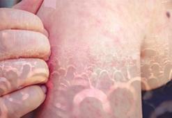 Yaşları 25, 30, 35... Grip sandı, kızamık çıktı! Kritik sınır 1998, ölüme götürebilir