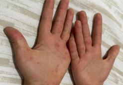 Sağlık Bakanlığı'ndan 81 ile 'kızamık' yazısı