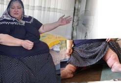 200 kiloya ulaşan fil hastası kadın, 7 yıldır evden çıkamıyor
