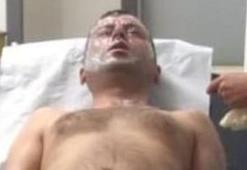 Tıkalı lavaboyu açıcıyla açmak istedi, patlamasıyla yaralandı