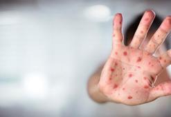 Kızamık tehlikesi devam ediyor! Uzman isim artışın sebebini açıkladı