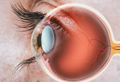 Göz önünde gölgeler ve uçuşmalar varsa dikkat! Erken tedavi edilmezse kör ediyor