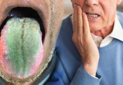 'Kıllı dil' kabusu! Antibiyotik alırken sigara da içti, bu yöntemle kurtuldu