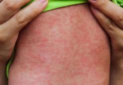 Kızamıkta artışında İstanbul Avrupa yakasını işaret etti! 8-10 yıl sonra ölümcül risk