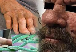 Gözler dünyadaki bu yere çevrildi! Orta Çağ hastalığı hortladı, vücudu sarıyor