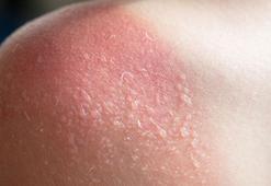 Güneş yanığı deyip geçmeyin! 'İyileşmeden asla dışarı çıkmayın'