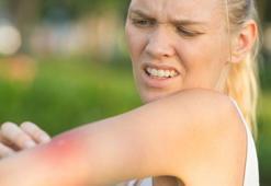 Yaz alerjisi deyip geçmeyin! İçlerinde ölüme kadar götüren bile var