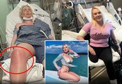 Et yiyen bakteri kabusu! İlaç verip eve gönderdikleri kadının bacağı kesildi