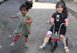 İki kardeşin sağ bacakları 1,5 yaşında kesildi! 'Mucize' gerçek oldu