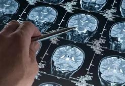 Bilim insanları Alzheimer hastalarında beyin hücrelerinin neden öldüğünü keşfetti