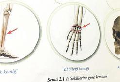 Kafatasına ‘kalça kemiği’ yazıldı