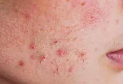 LUPUS HASTALIĞI NEDİR, BELİRTİLERİ NELER? (Lupus) Kelebek hastalığı bulaşıcı mı?