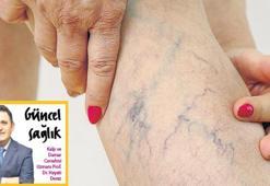 Niçin ‘Varislerinizi ilerlemeden tedavi ettirin’ diyoruz?