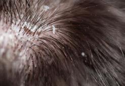 Egzama, kaşıntı kepek problemini kökünden kazıyor… İster şampuana ekleyin ister doğrudan uygulayın