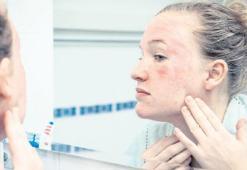 Uyuz, 15 dakikalık temasla bulaşıyor