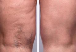 'Biyolojik yapıştırma' ile anesteziye elveda! Varislerden ameliyatsız kurtarıyor