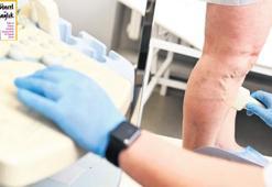 Çağımızın hastalığı: Varis