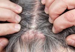 Saç dökülmesi ve kepeğe tek damlalık çözüm! Egzama ve kaşıntıdan eser bırakmıyor