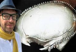 Kafatasından çıkan parçayı vücuduna diktiler! 1 ay sonra uyandığında hayatının şokunu yaşadı