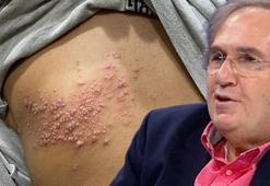 Saraçoğlu kürüyle zona derdine son! Günde bir kez içmek şifa oluyor