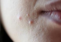 Cildi günden güne öldürüyor! Alışkanlıklar yüzü mahvediyor