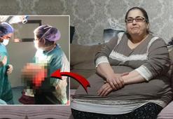 Hareket etmekte güçlük çekiyordu! Vücudundan 25 kiloluk yağ dokusu çıkarıldı