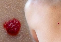 Ciltte bir anda çıkıyor, rengi de kırmızı! Kimse bilmiyor ama meğer sebebi buymuş