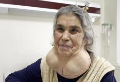50 yıl boyunca hastaneye gitmedi, 2 kiloluk kitleyle bir ömür yaşadı