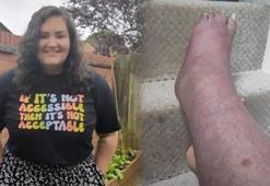 'Bacağımı kesin' diye yalvardı! Delirten ağrı ve şişlik hayatını böyle mahvetti