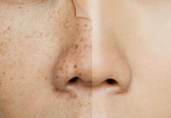 Cilt lekelerinizden korkmayın! Yaz ve kış demeden güneş kremi kullanın