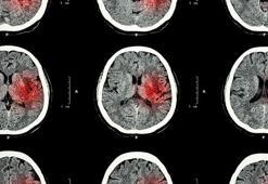 Ani baş dönmesi felç işareti olabilir! 55 yaş üstünü özellikle uyardı