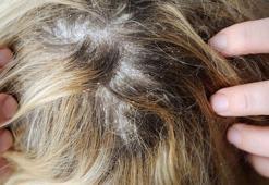 Bir damlası saç derisinde mucizeler yaratıyor! Egzama, kepek ve kaşıntıyı geçiriyor