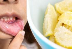 Ağızda çıkan uçuklara kesin çözüm! Limon-tuz-karabiber üçlüsü resmen ilaç gibiymiş