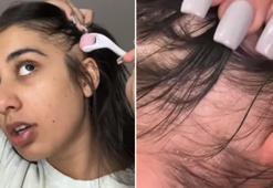 Aldığı 300 liralık ürünle kellikten kurtuldu! Tam 18 günde saçları çıktı