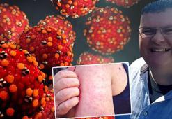 20 yıldır görülmeyen hastalık şoförü öldürdü! Gerçeği kardeşi açıkladı: 'Tek çaresi var'