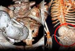 Karnından taşlaşmış bebek çıktı! Doktorlar tespiti yapar yapmaz öldü, akılalmaz olay