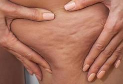 Kadınların korkulu rüyası! Selülit sadece kilolu kişilerde mi görülür?
