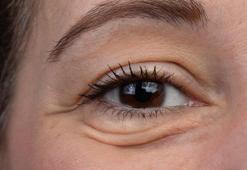 Gözleriniz şişiyorsa dikkat! Bu yiyeceklerden uzak durun