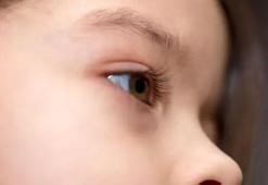 Çocuğunuzun göz altlarında koyu halkalar mı var? Mantıklı bir açıklaması olabilir