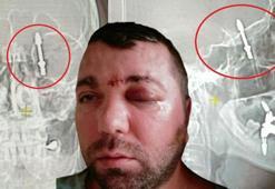 Amerikan dergilerine konu olan Türk! Beyne saplanan vida