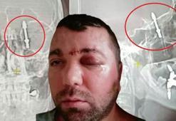 İmplant tedavisinde vida beynine saplandı