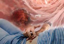 Bağırsaktan vuruyor! Görülme yaşı 20'lere düştü: İlk sinyali böyle veriyormuş, işte çaresi