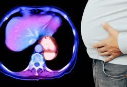 Karnındaki bovling topu değil, dev fıtıkmış! 'Tomografi çektirdiğinde öğrenenler var'