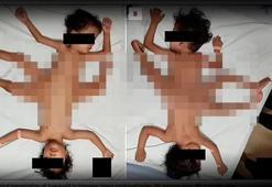 Örümcek ikizler infial yarattı! Amerikan dergisi yayınladı: Tek vücut, üç bacak, dört kol